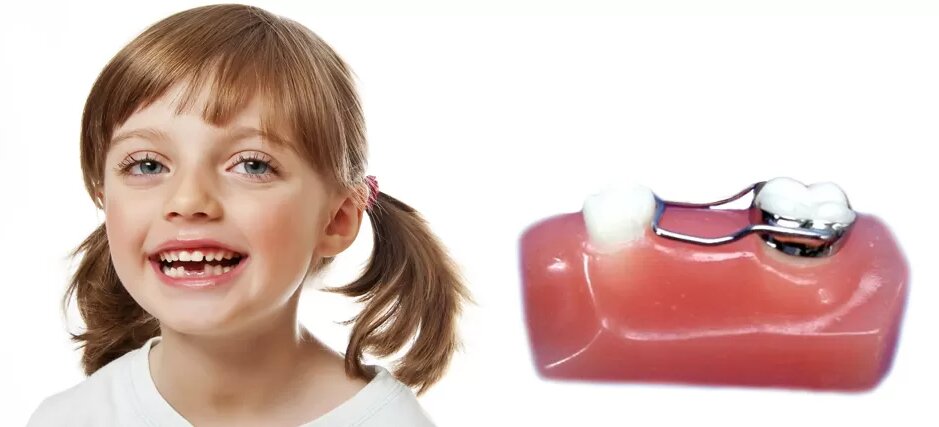 When Does a Child Need a Space Maintainer for Teeth?