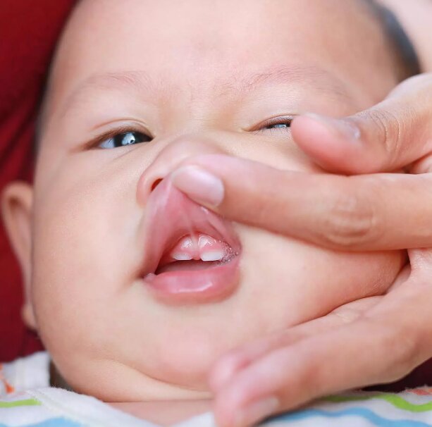 Does Your Child Need a Tongue or Lip-Tie Release? What to Know