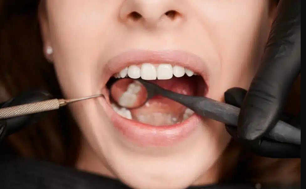 Understanding Enamel Erosion and How to Prevent It
