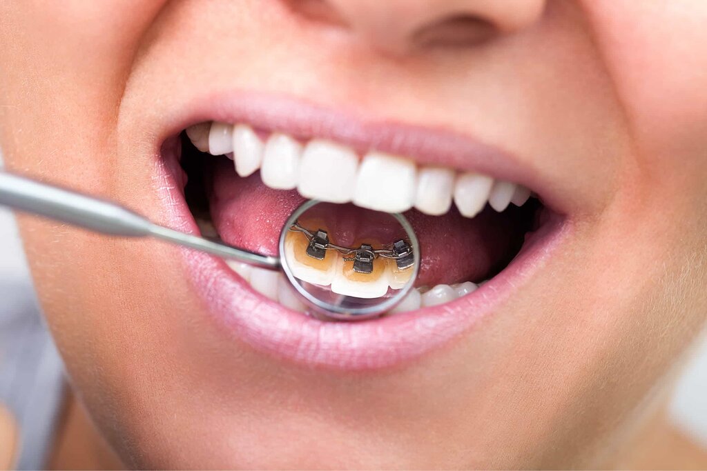 Why More Adults Are Choosing Lingual Braces for Treatment