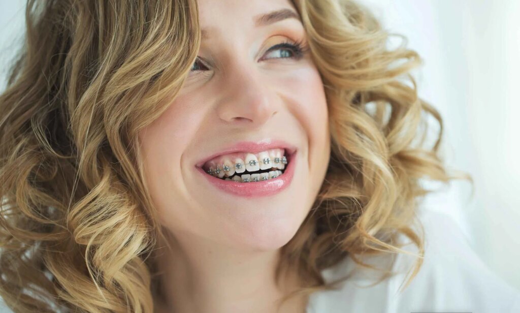 The Different Types of Braces Available Today