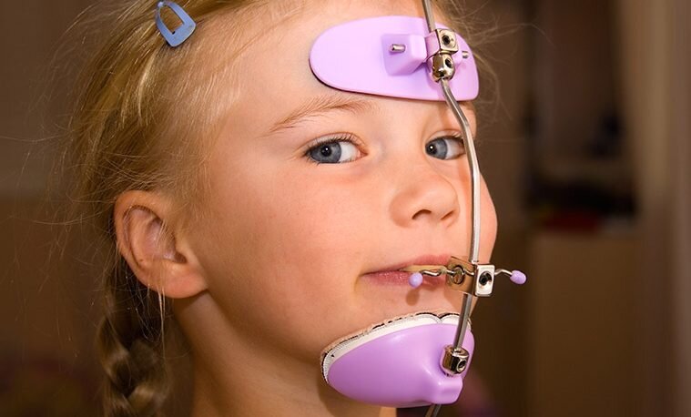 Facial Mask Therapy for Underbite: What Parents Should Know