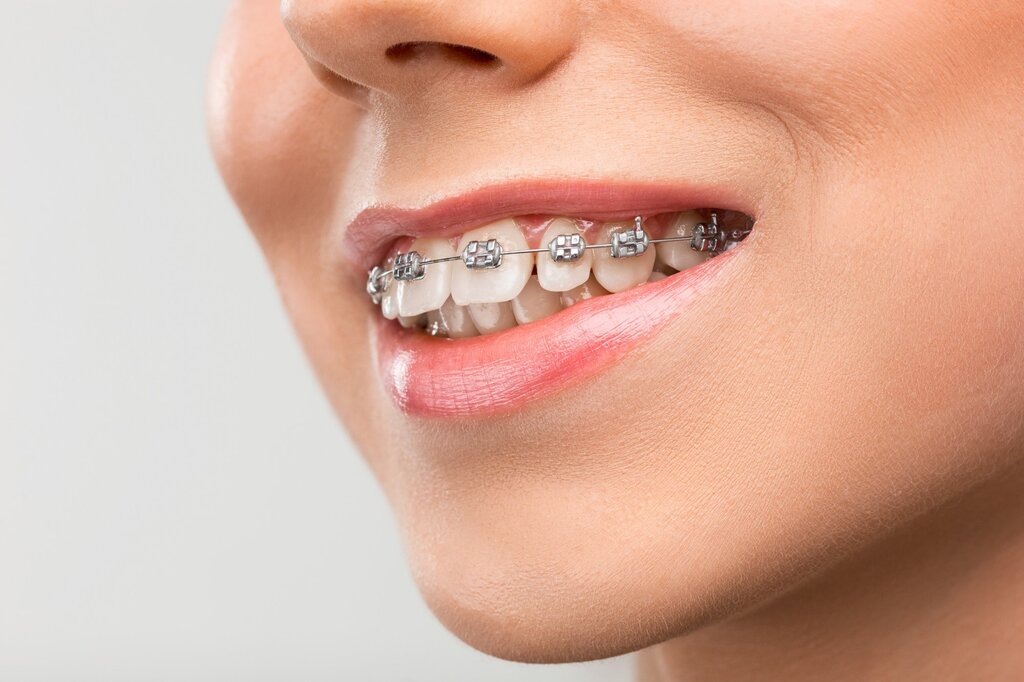 Metal Braces in the Modern Age: Why they’re Still a Smart Choice
