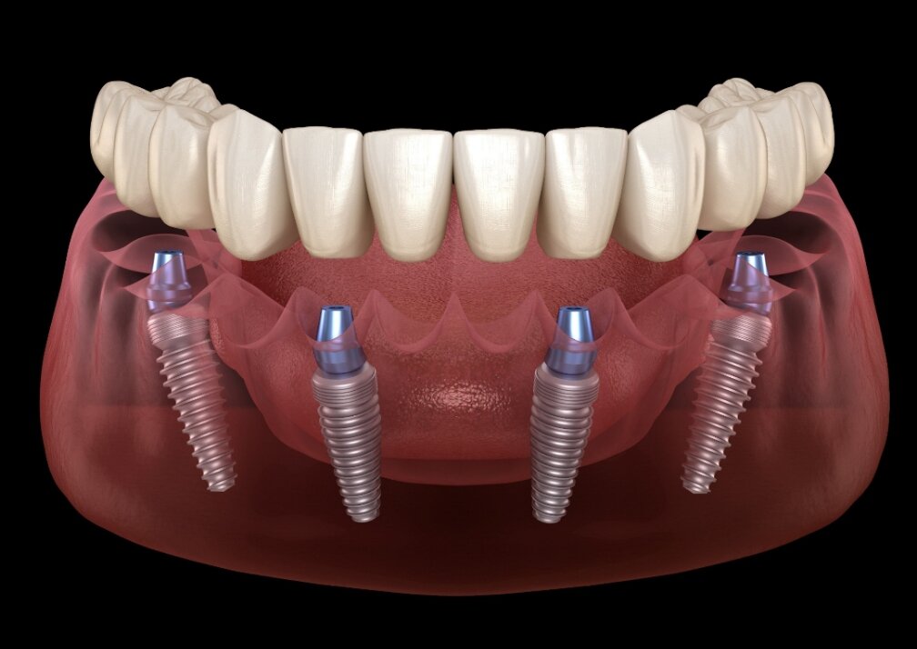 How Long Do Dental Implants Last? A Complete Guide for Patients in 2026