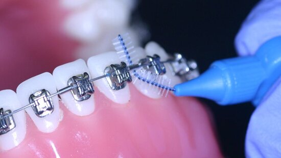 The Ultimate First Week Braces Survival Guide