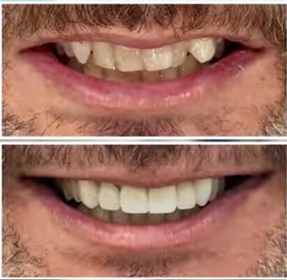 Same-Day Smile Makeover in Tampa Bay: Real Patient Story & Results