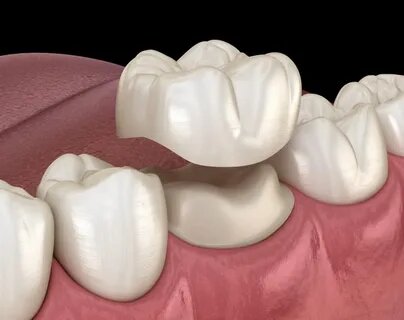 How Long Does a Ceramic Crown Last? Here's What Affects Its Lifespan
