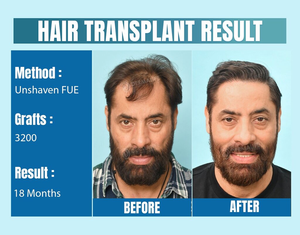 Can Hair Transplant Provide Natural Looking Permanent Results?