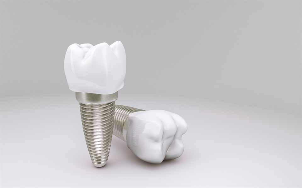 Dental Implants Longevity: A Journey of Smile Restoration