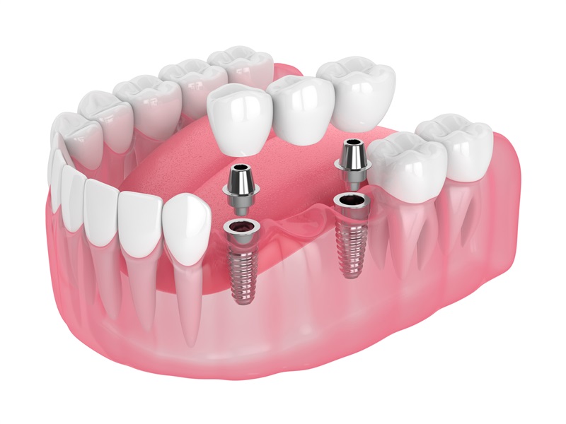 Smile Savers: Navigating the Quest for Affordable Excellence in Dental Implants Therapy
