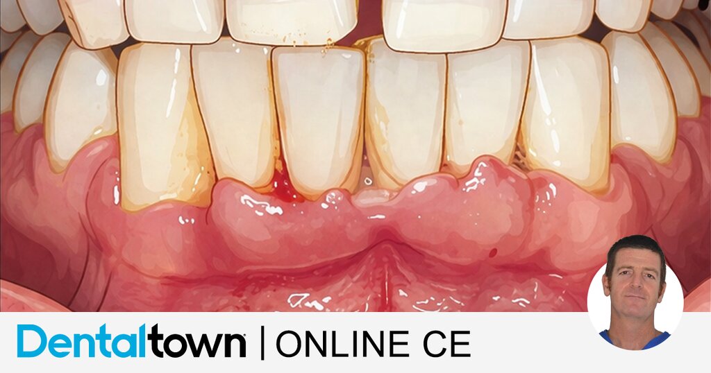 Periodontal Diagnosis: Demystifying the 2017 Nomenclature by Dr. Giacomo Tarquini