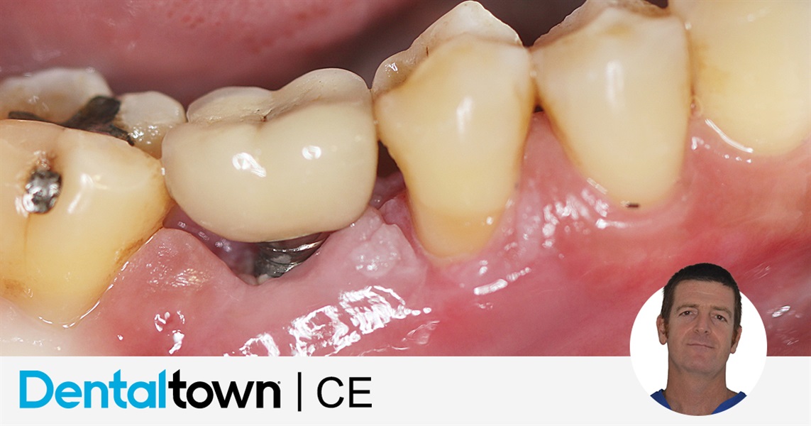 Peri-Impantitis: Its Diagnosis and Management by Dr. Giacomo Tarquini