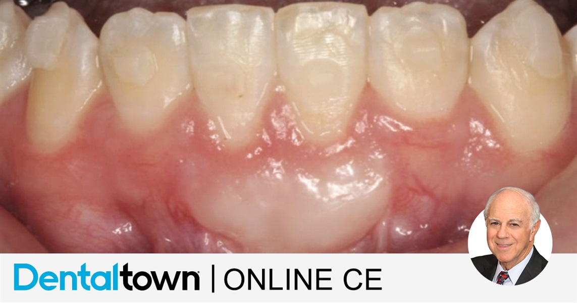 Improving Restorative Results with Soft-tissue Grafting by Dr. James Kohner