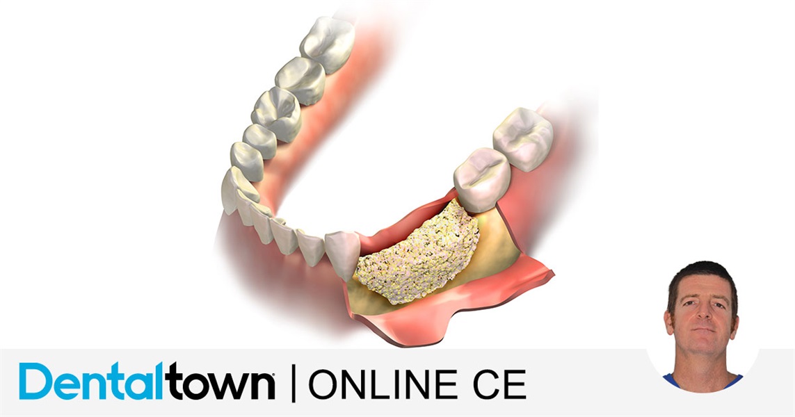 All You Ever Needed to Know About Guided Bone Regeneration by Dr. Giacomo Tarquini