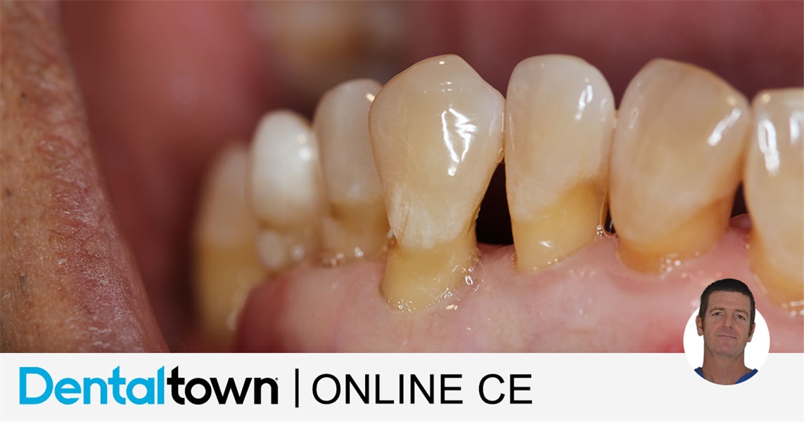 Mucogingival Aesthetic Surgery by Dr. Giacomo Tarquini