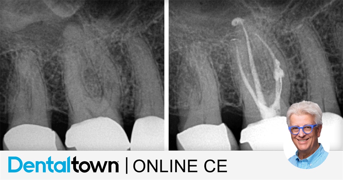 Rethinking Expectations in Endodontics with The Laser Advantage: Part 3
