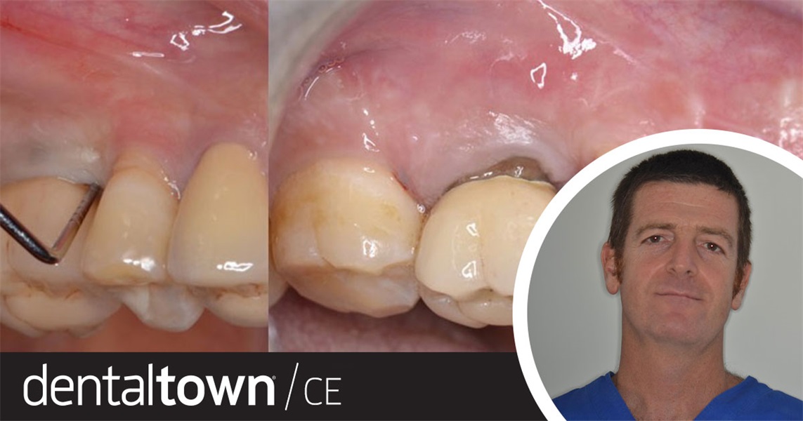 Osseous Resective Surgery