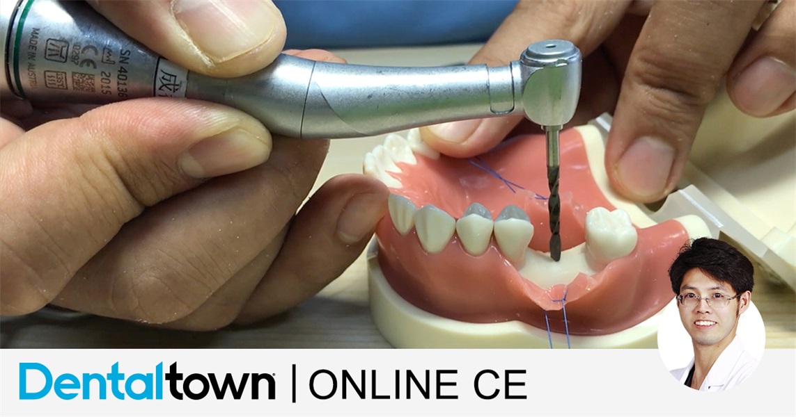 Long-term Single Implant Survival by Dr. Zhouyu Ding