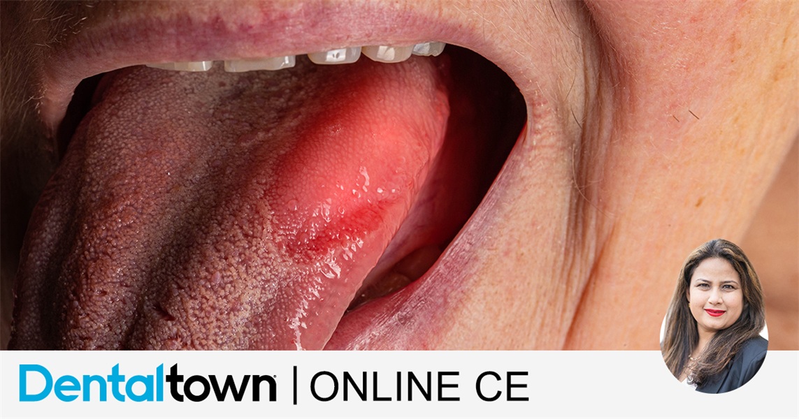 Oral cancer, a journey of cancer, grief and finding a purpose by Dr. Parul Dua Makkar